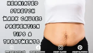 Herniated Stretch Mark